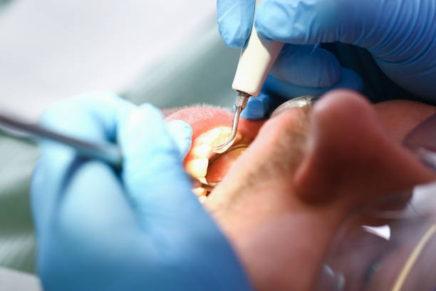 Best Emergency Root Canal Treatment in Fayetteville, NC