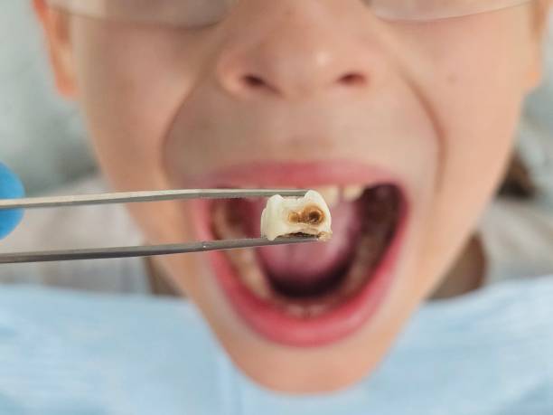 Best Emergency Dental Care for Abscessed Tooth in Fayetteville, NC